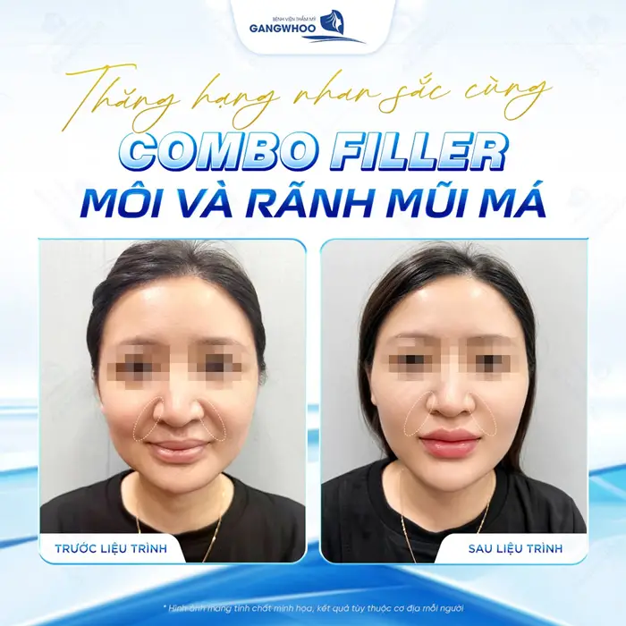 Thăng hạng nhan sắc cùng combo Filler tiêm rãnh mũi má sau 1 liệu trình đã hoàn toàn khác biệt 