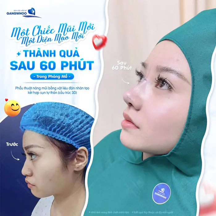 Nâng Mũi Perfect Giải Pháp Cho Dáng Mũi Hoàn Hảo Đẹp Như Mơ 4 Thành quả sau 60 phút trong phòng mổ dáng mũi mới cao đẹp hài hòa đẹp chuẩn tỷ lệ của khuôn mặt