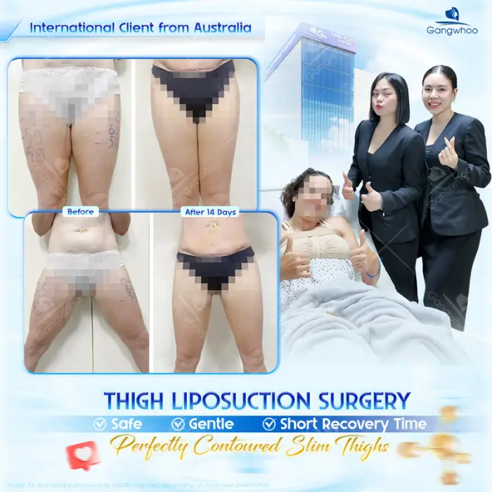 thigh liposuction 1