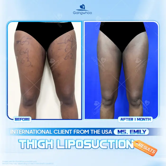 thigh liposuction 2