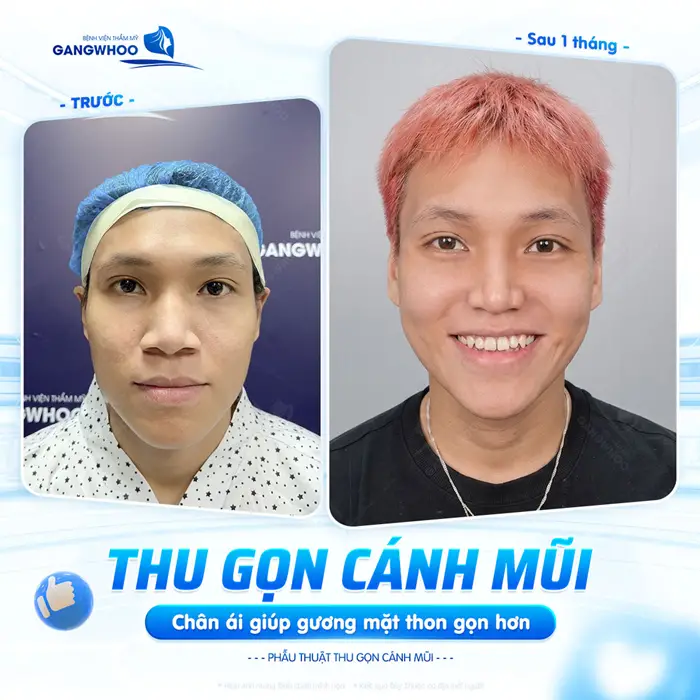 Thu gọn cánh mũi chân ái giúp gương mặt thon gọn, hài hòa hơn thấy rõ