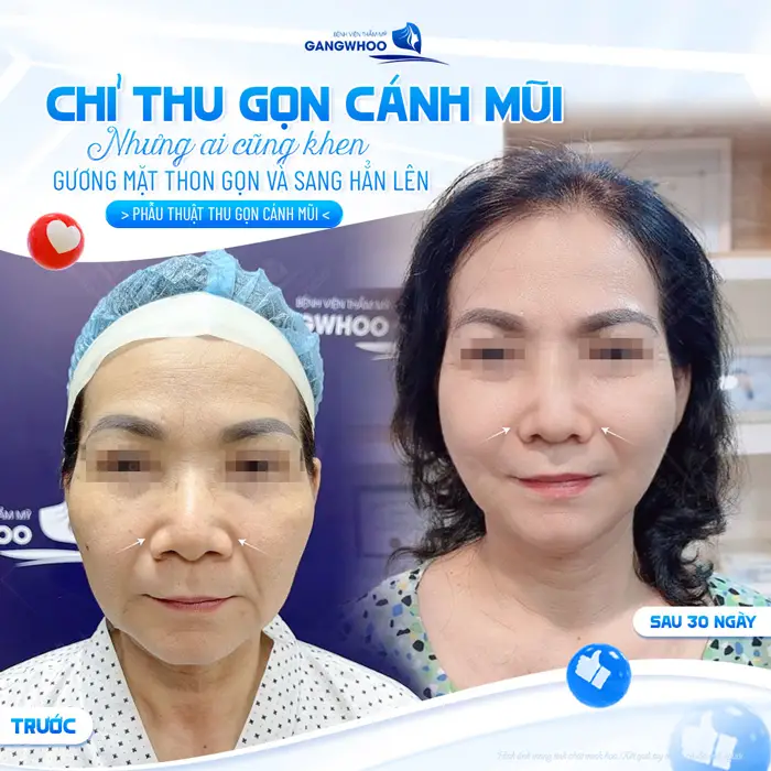 Phẫu Thuật Thu Gọn Cánh Mũi Khắc Phục Mũi To Bè Trở Nên Thon Gọn 19 Chỉ thu gọn cánh mũi nhưng gương mặt và thần sắc cũng đẹp thăng hạng thấy rõ