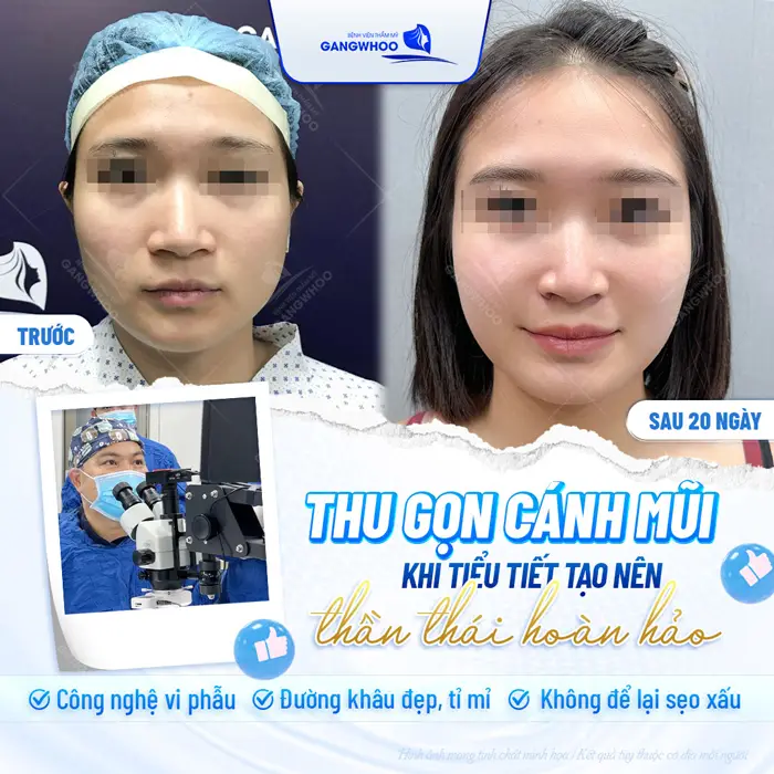 Phẫu Thuật Thu Gọn Cánh Mũi Khắc Phục Mũi To Bè Trở Nên Thon Gọn 1 Thu gọn cánh mũi khi tiểu tiết tạo nên thần thái hoàn hảo và tràn đầy tự tin