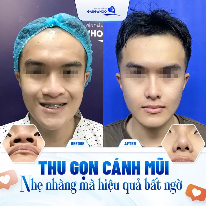 Thu Gọn Cánh Mũi Khắc Phục Mũi To Bè Trở Nên Thon Gọn 3 Thu gọn cánh mũi giải pháp nhẹ nhàng mà hiệu quả cải thiện đầy bất ngờ
