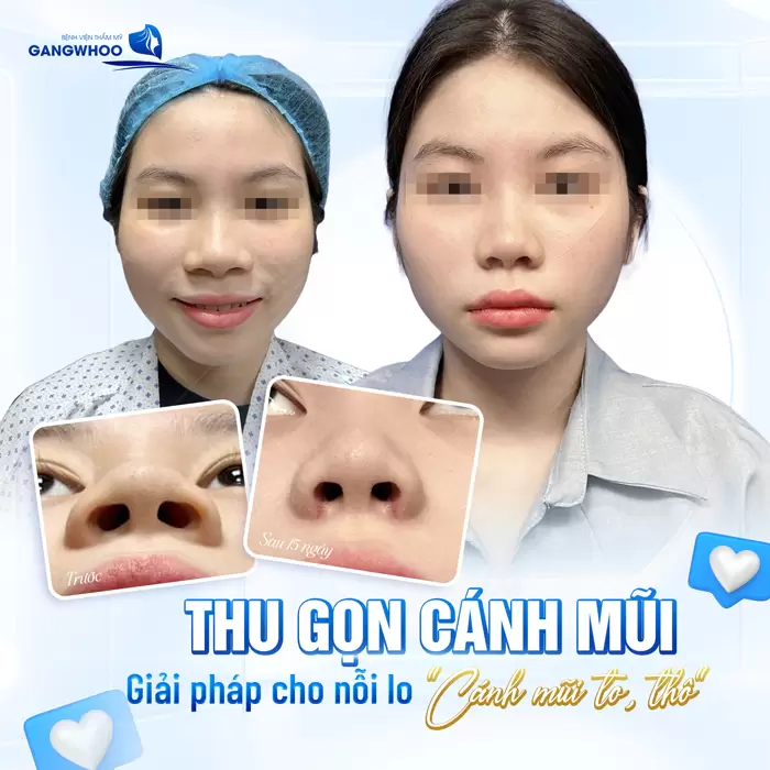 Phẫu Thuật Thu Gọn Cánh Mũi Khắc Phục Mũi To Bè Trở Nên Thon Gọn 4 Thu gọn cánh mũi giải pháp cho nỗi lo cánh mũi to, thô một cách hiệu quả và nhanh chóng