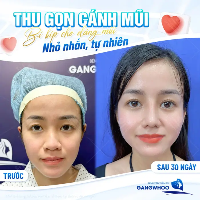 Phẫu Thuật Thu Gọn Cánh Mũi Khắc Phục Mũi To Bè Trở Nên Thon Gọn 2 Thu gọn cánh mũi bí kíp cho dáng mũi nhỏ nhắn, tự nhiên sau 30 ngày thực hiện