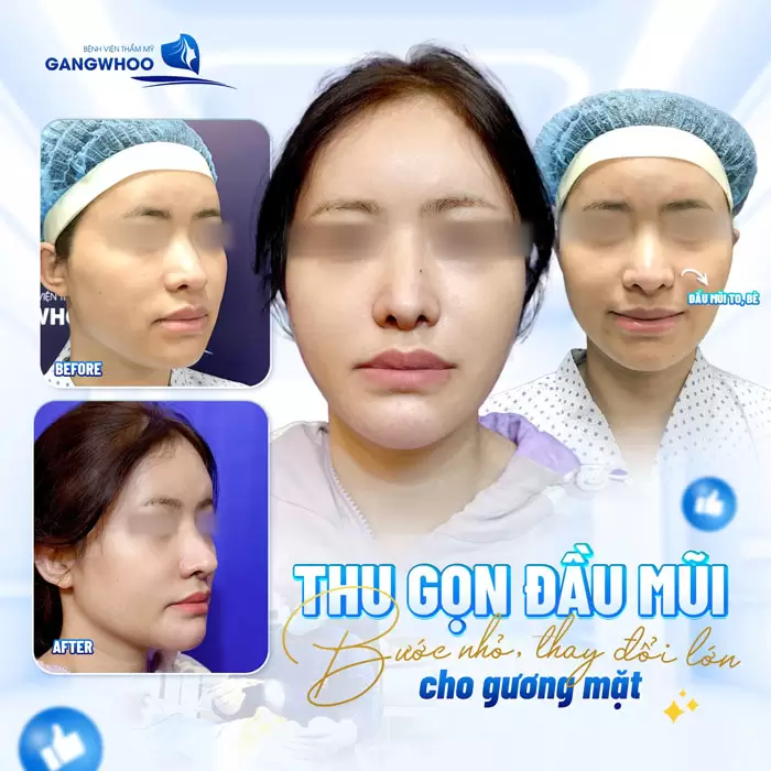 Thu Nhỏ Đầu Mũi Dao Siêu âm: Giải Pháp Cho Người Mũi To 2 Thu nhỏ đầu mũi bước nhỏ thay đổi lớn cho gương mặt thêm toàn diện
