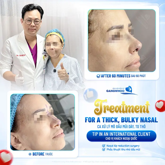 Xử lý đầu mũi dày, to thô cho cho vị khách ngoại quốc sau 60 phút đã hoàn toàn khác biệt 