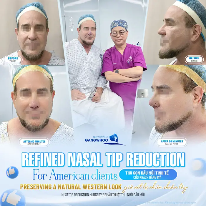 Thu nhỏ đầu mũi cải thiện dáng mũi thiếu hài hòa một cách hiệu quả, an toàn chỉ sau 60 phút thực hiện