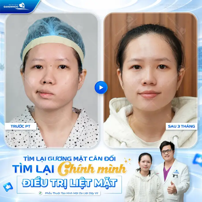 Tìm lại gương mặt cân đối khôi phục lại diện mạo thêm hài hòa sau điều trị liệt mặt tại BVTM Gangwhoo