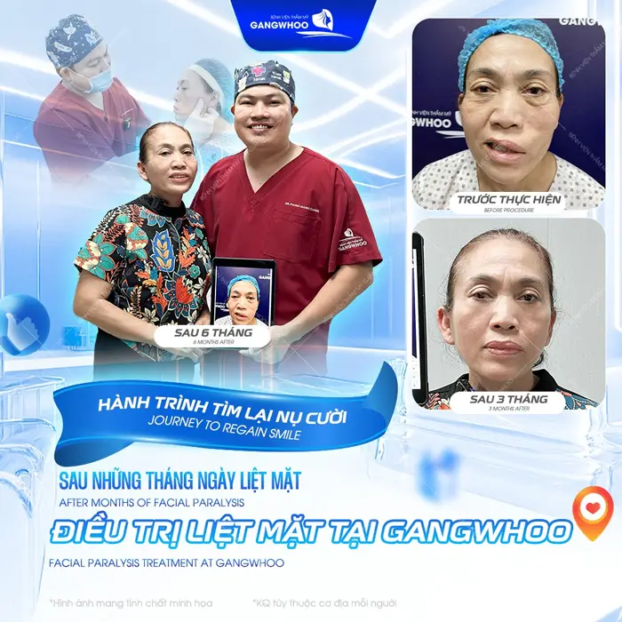 Điều Trị Liệt Mặt Nội Soi 4K - Lấy Lại Nụ Cười Trên Gương Mặt 4 Hành trình tìm lại nụ cười rạng rỡ không còn liệt mặt sau 3 tháng phẫu thuật