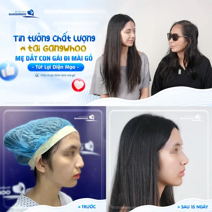 Tin tưởng chất lượng tại Gangwhoo mẹ dắt con gái đi mài gồ tút lại diện mạo sau 15 ngày đã hoàn toàn khác biệt 