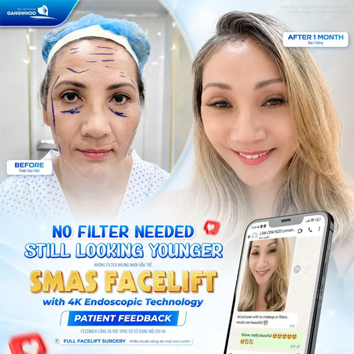 Diện mạo trẻ hơn, đẹp hơn sau phẫu thuật căng da mặt Smas ứng dụng nội soi 4K