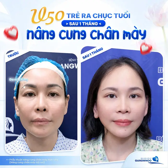 Phẫu Thuật Treo Cung Mày Trực Tiếp Nội Soi (Nâng Cung Chân Mày) Thổi Bay Dấu Hiệu "Lão Hóa" 8 U50 trẻ ra vào chục tuổi sau 1 tháng nâng cung chân mày