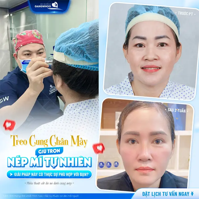 Treo cung chân mày giữ trọn nếp mí tự nhiên giải pháp cho đôi mắt đẹp tươi trẻ và sáng rõ