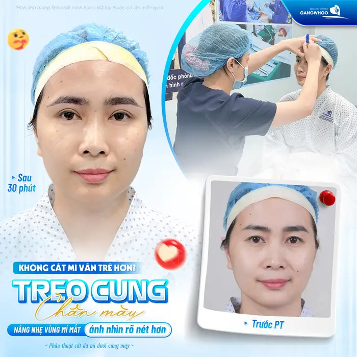 Treo cung chân mày nâng nhẹ vùng mí mắt ánh nhìn rõ nét và trở nên tươi tắn hơn 