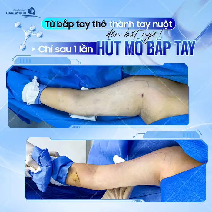 Hút Mỡ Cánh Tay Giúp Lấy Lại Đôi Tay Thon Gọn Nhanh Chóng 4 Chỉ sau 1 lần hút mỡ bắp tay từ tay thô thành tay thon nuột gọn gàng