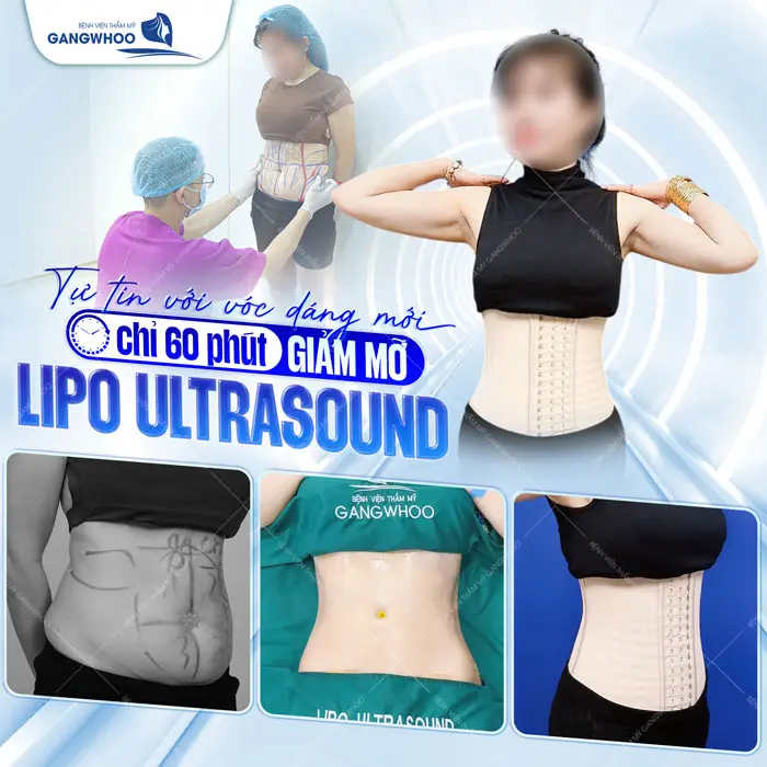 Lipo Ultrasound: Công Nghệ Hút Mỡ Được Nhiều Khách Quốc Tế Lựa Chọn 62 Lipo Ultrasound
