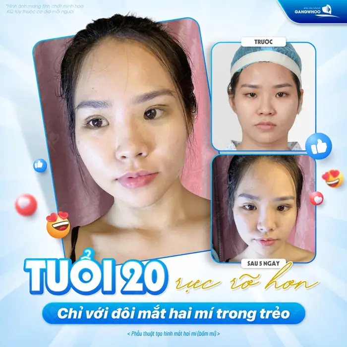 Tuổi 20 rực rõ hơn chỉ với đôi mắt 2 mí trong trẻo ngay sau 5 ngày đã hoàn toàn lột xác