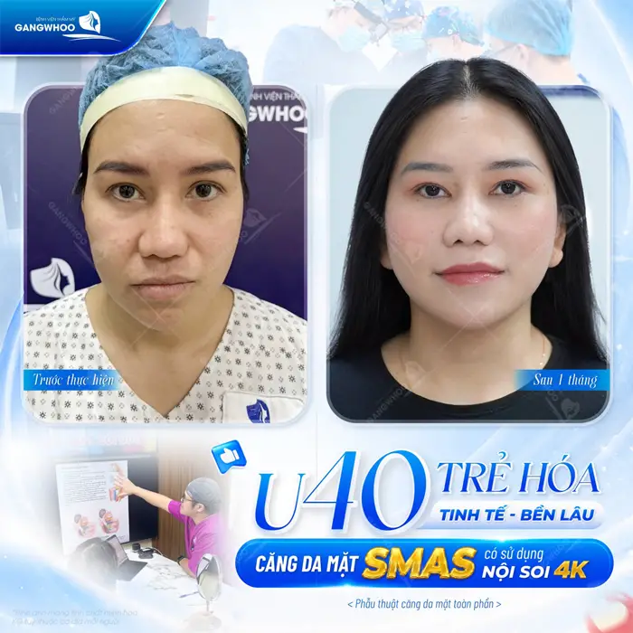 U40  trẻ hóa tinh tế và đẹp bền lâu sau căng da mặt Smas nội soi 4K