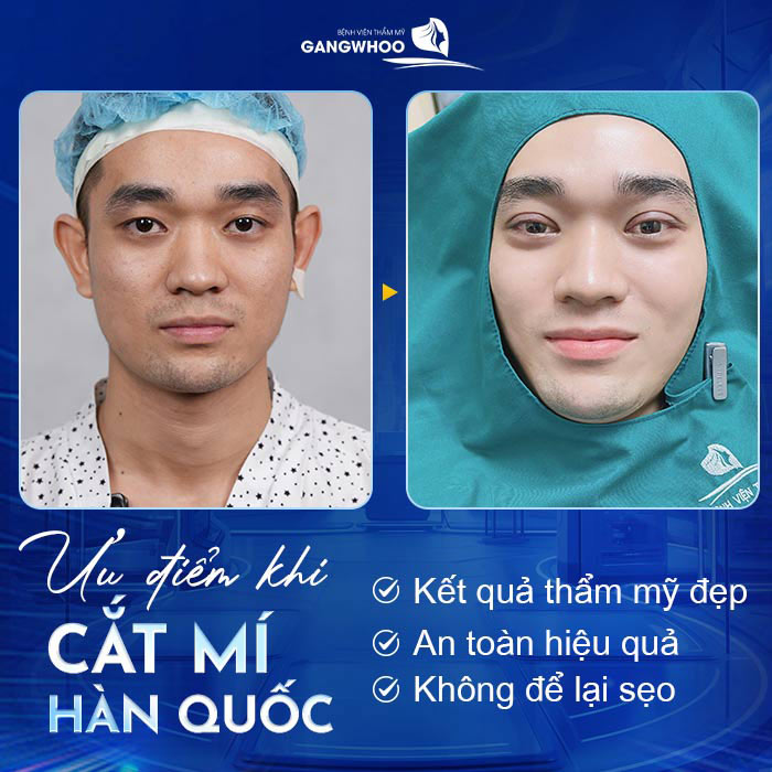 Cắt Mí Hàn Quốc Cho Bạn Đôi Mắt 2 Mí Đẹp Chuẩn "Sao Hàn" 21 Cắt mí Hàn Quốc