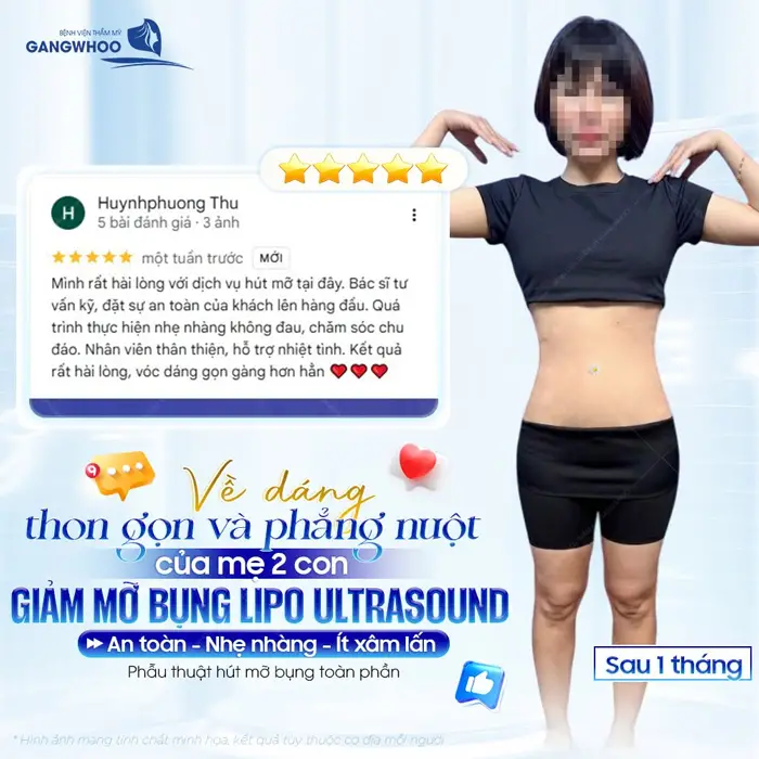 Hút Mỡ Bụng (Lipo Ultrasound) Hiệu Quả, Không Sưng Bầm 37 ve dang thon gon va phang nuot cua m e 2 con sau giam mo bung lipo ultrasound