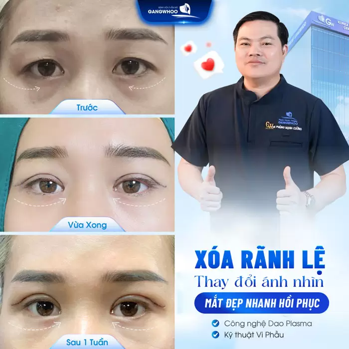 Xóa Rãnh Lệ Lấy Lại Nét Thanh Xuân Vốn Có Của Bạn 2 Xóa Rãnh Lệ Lấy Lại Nét Thanh Xuân Vốn Có Của Bạn