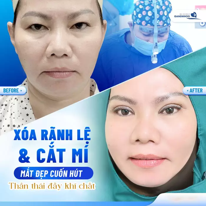 Xóa Rãnh Lệ Lấy Lại Nét Thanh Xuân Vốn Có Của Bạn 14 Xóa Rãnh Lệ Lấy Lại Nét Thanh Xuân Vốn Có Của Bạn