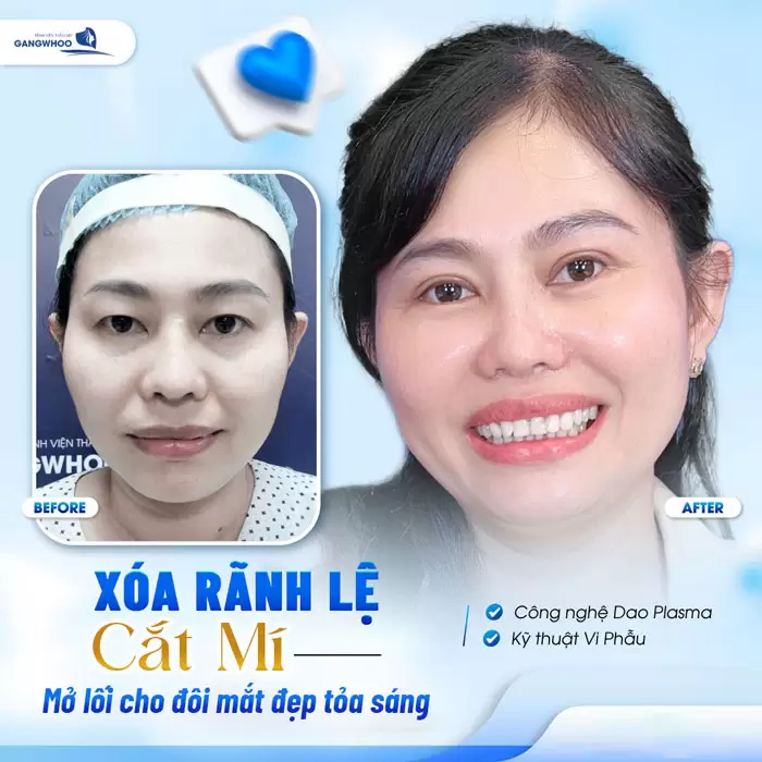 Xóa Rãnh Lệ Lấy Lại Nét Thanh Xuân Vốn Có Của Bạn 12 Xóa Rãnh Lệ Lấy Lại Nét Thanh Xuân Vốn Có Của Bạn
