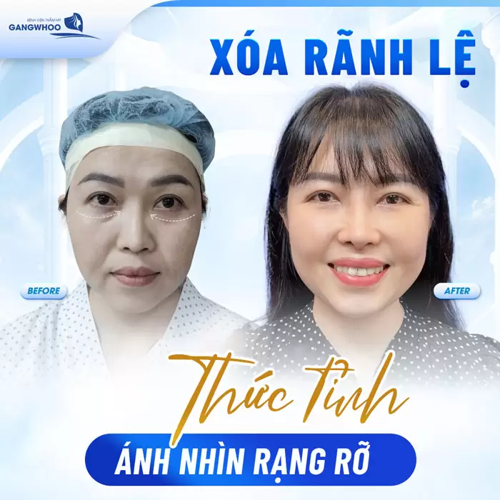 Xóa Rãnh Lệ Lấy Lại Nét Thanh Xuân Vốn Có Của Bạn 1 Xóa Rãnh Lệ Lấy Lại Nét Thanh Xuân Vốn Có Của Bạn