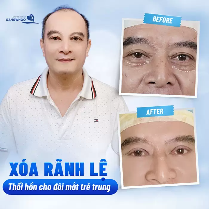 Xóa Rãnh Lệ Lấy Lại Nét Thanh Xuân Vốn Có Của Bạn 3 Xóa Rãnh Lệ Lấy Lại Nét Thanh Xuân Vốn Có Của Bạn