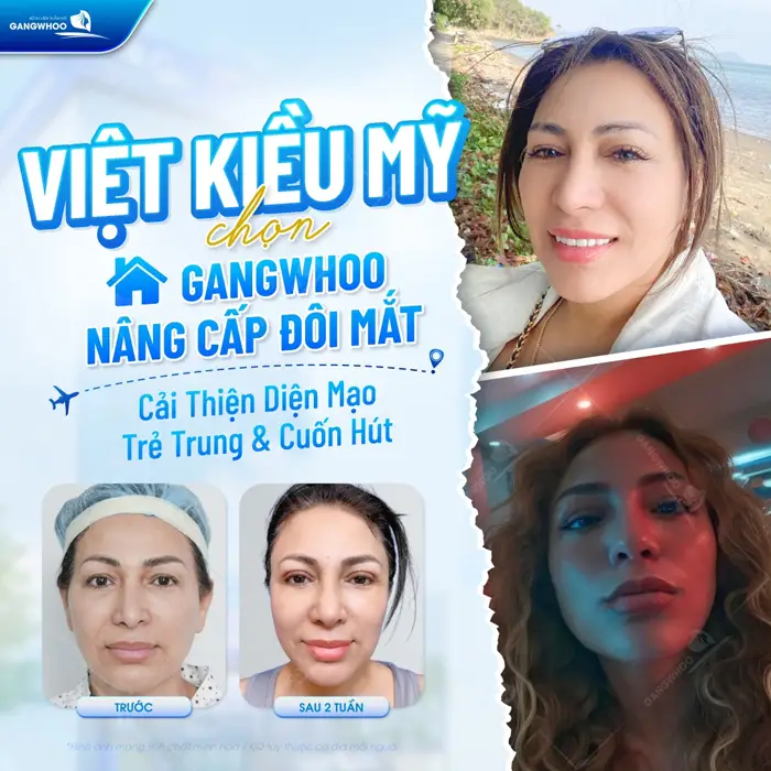 Việt Kiều Mỹ chọn Gangwhoo nâng cấp đôi mắt cải thiện diện mạo đầy trẻ trung và cuốn hút