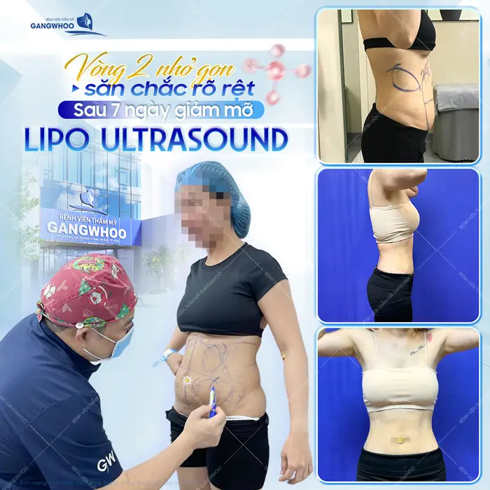 Vòng 2 nhỏ gọn sắc chắc rõ rệt sau 7 ngày giảm mỡ công nghệ (Lipo Ultrasound)