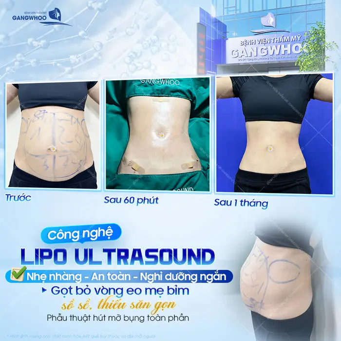 Công nghệ giảm mỡ bụng Lipo Ultrasound nhẹ nhàng, an toàn và nghỉ dưỡng ngắn sau 1 tháng đã hoàn toàn khác biệt