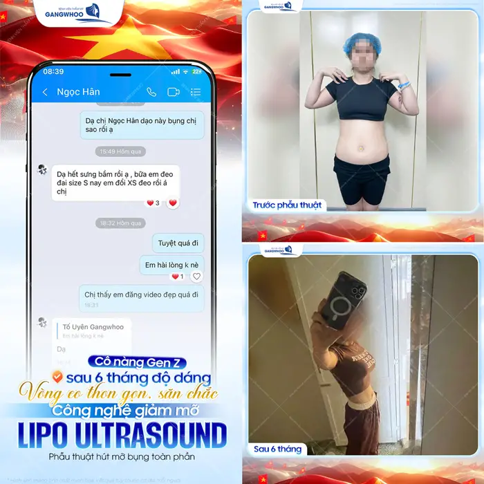 vong eo thon gon va san chac voi cong nghe lipo ultrasound khach hang fb sau 6 thang thuc hien
