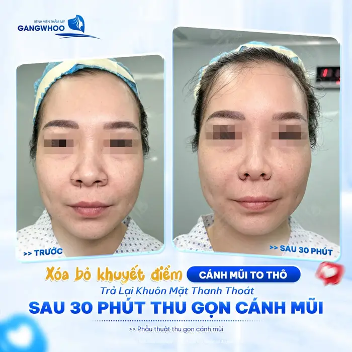 Xóa bỏ khuyết điểm cánh mũi thô to trả lại khuôn mặt thanh thoát sau 30 phút thực hiện