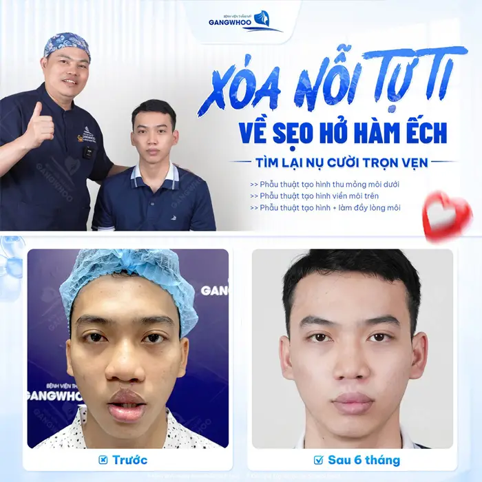 Xóa nỗi tự ti về sẹo hở hàm ếch tìm lại nụ cười trọ vẹn sau can thiệp 