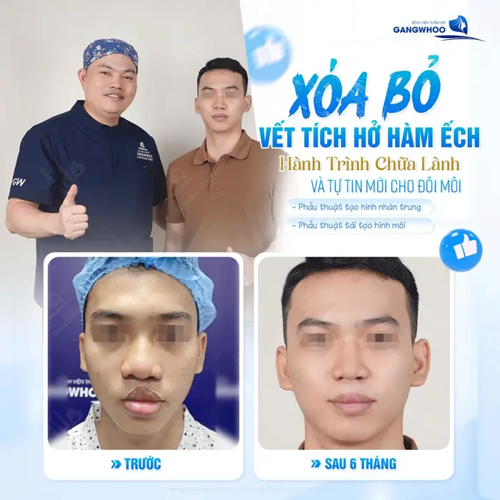 Xó bỏ vết tích hở hàm ếch hành trình chữa lành và tự tin cho đôi môi an toàn tại bệnh viện thẩm mỹ Gangwhoo 