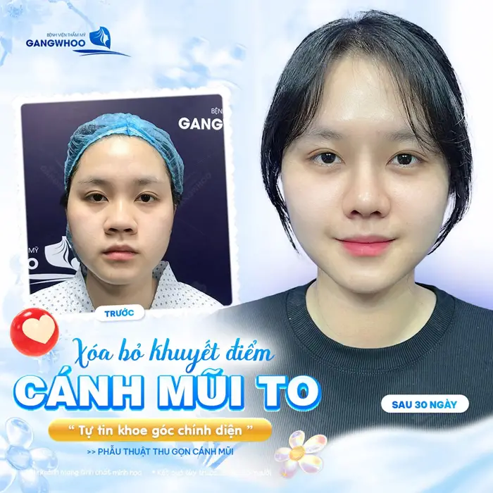 Loại bỏ khuyết điểm cánh mũi to tự tin khoe góc chính diện với diện mạo hài hòa, tự nhiên và thăng hạng hơn thấy rõ
