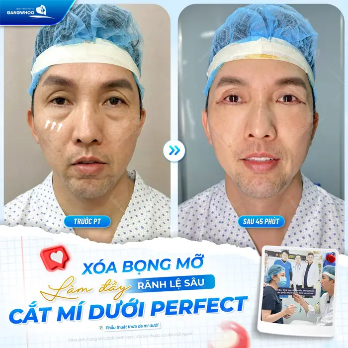 Xóa bọng mỡ làm đầy rãnh lệ sâu sau cắt mí dưới Perfect tại bệnh viện thẩm mỹ Gangwhoo 