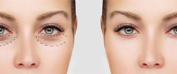 Tear Trough Removal For Younger eyes