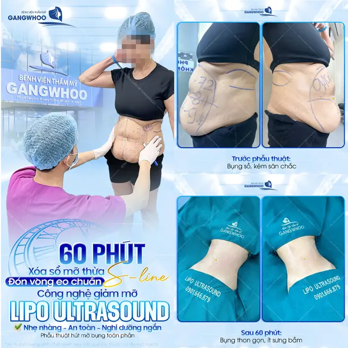 60 phút xóa sổ mỡ thừa với vòng eo S Line thon gọn đẹp đến khó tin