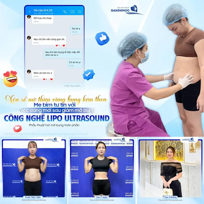 Hút Mỡ Toàn Thân An Toàn, Không Biến Chứng, Hiệu Quả Cao 32 xoa so mo thua vung bung kem thon voi dang mui sau giam mo bung lipo ultrasound