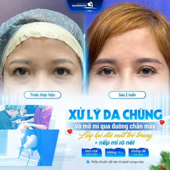Xử lý da chùng và mỡ mí qua đường chân mày nếp mí rõ nét và hạn chế sưng đau hiệu quả