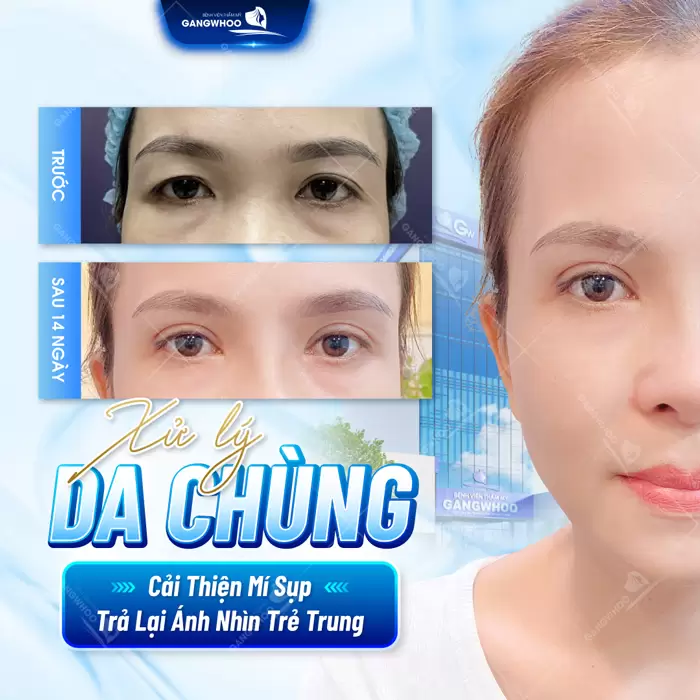 Không còn bọng mắt dưới cải thiện da chùng hiệu quả cải thiện ánh nhìn thêm phần trẻ trung