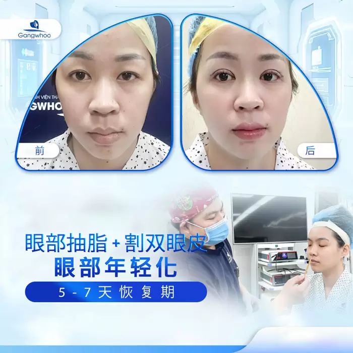 zh lay mo mat noi soi 1