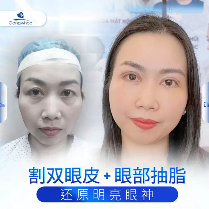 zh lay mo mat noi soi 4