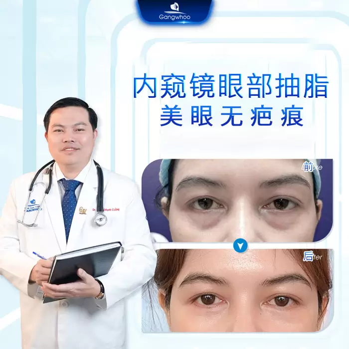 zh lay mo mat noi soi 6