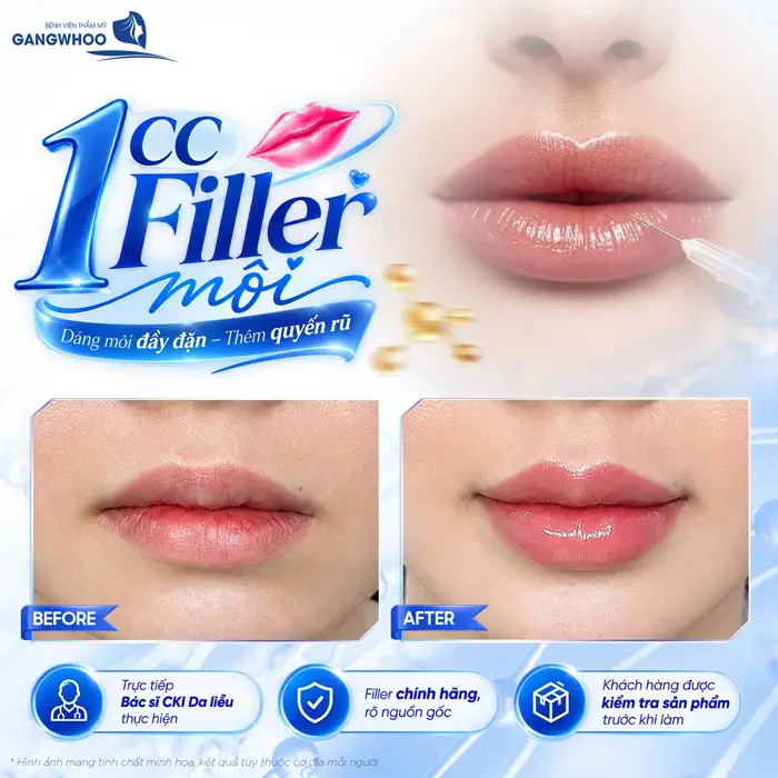 Thẩm Mỹ Trẻ Hóa Môi - Cho Đôi Môi Căng Mọng Quyến Rũ 1 Tiêm 1 CC Filler dáng môi đầy đặn diện mạo thêm quyến rũ và trẻ đẹp đầy bất ngờ