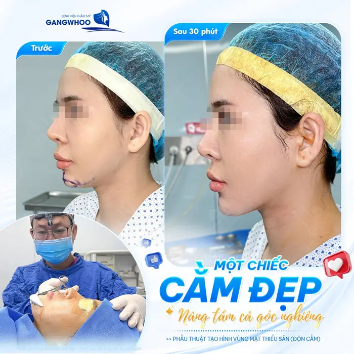 Độn Cằm Korea Implant Sở Hữu Gương Mặt V-Line Nhanh Chóng 13 1 chiếc cằm đẹp nâng tầm cả góc nghiêng giải pháp hoàn hảo cho diện mạo bừng khí chất